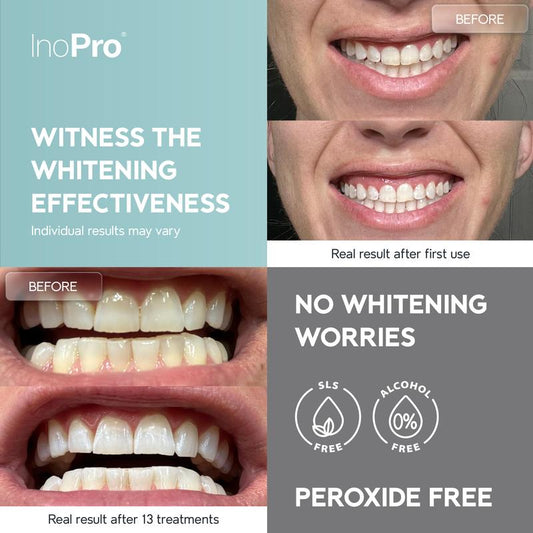 Inopro Natural Teeth Whitening Strips - Pack of 28